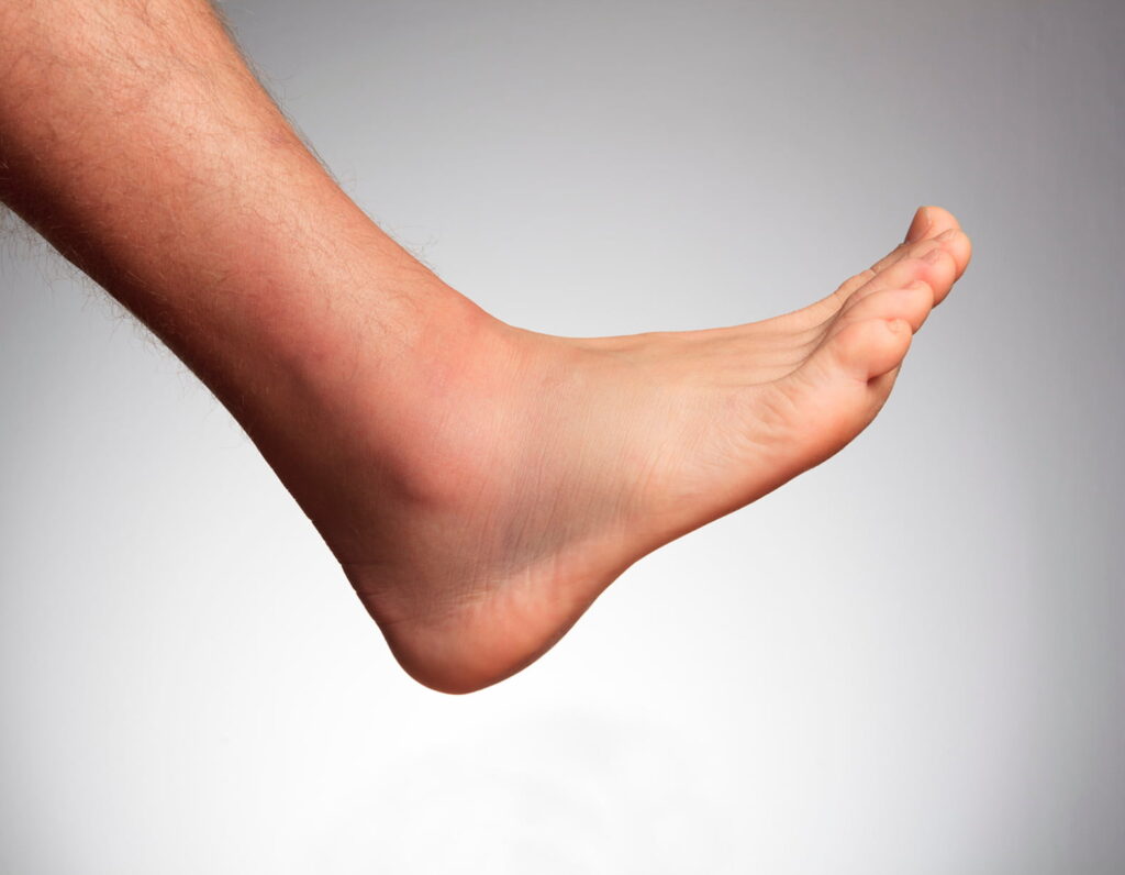 Swelling foot